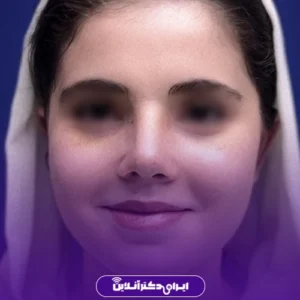 نمونه کار عمل بینی دکتر شبنم حاجی علی پور 2