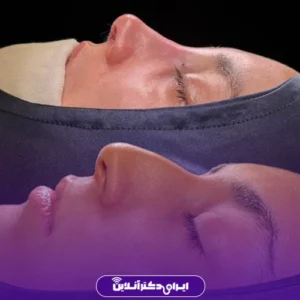 نمونه کار عمل بینی دکتر شبنم حاجی علی پور 3