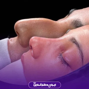 نمونه کار عمل بینی دکتر شبنم حاجی علی پور 6