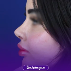 نمونه کار عمل بینی دکتر شبنم حاجی علی پور 7