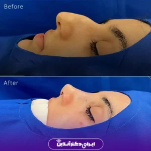 نمونه کار عمل بینی دکتر شبنم حاجی علی پور 8