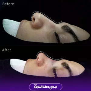 نمونه کار عمل بینی دکتر شبنم حاجی علی پور 9