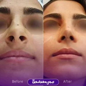 نمونه کار عمل بینی دکتر شادی جوادی 10