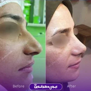 نمونه کار عمل بینی دکتر شادی جوادی 2