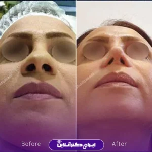 نمونه کار عمل بینی دکتر شادی جوادی 3