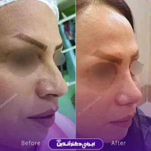 نمونه کار عمل بینی دکتر شادی جوادی 4