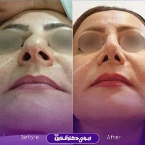 نمونه کار عمل بینی دکتر شادی جوادی 5
