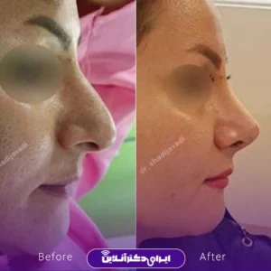 نمونه کار عمل بینی دکتر شادی جوادی 6