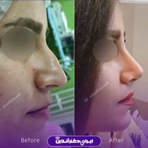 نمونه کار عمل بینی دکتر شادی جوادی 7