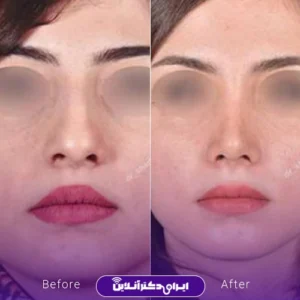 نمونه کار عمل بینی دکتر شادی جوادی 8