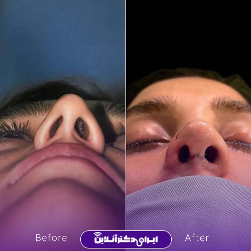 بهترین جراح بینی ترمیمی در تهران؛ معرفی 17 پزشک برتر 79 Dr. Shahrokh Khoshsirats rhinoplasty portfolio10