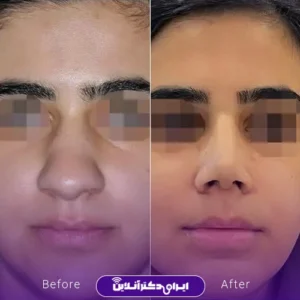 نمونه کار عمل بینی دکتر شیما کمندی 1