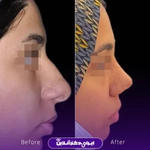 نمونه کار عمل بینی دکتر شیما کمندی 10
