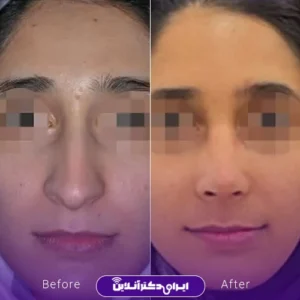 نمونه کار عمل بینی دکتر شیما کمندی 2
