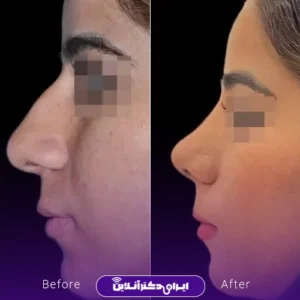 نمونه کار عمل بینی دکتر شیما کمندی 3