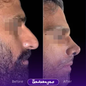 نمونه کار عمل بینی دکتر شیما کمندی 4