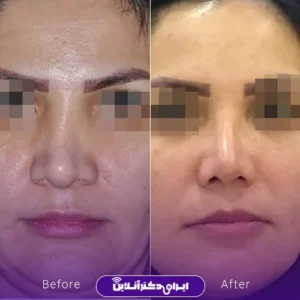 نمونه کار عمل بینی دکتر شیما کمندی 5