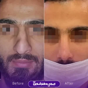نمونه کار عمل بینی دکتر شیما کمندی 6