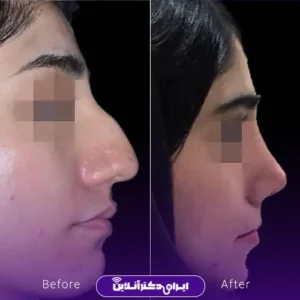 نمونه کار عمل بینی دکتر شیما کمندی 7