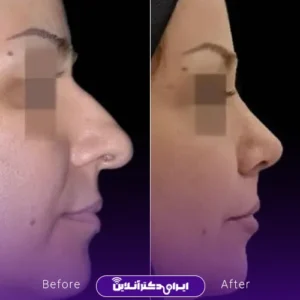نمونه کار عمل بینی دکتر شیما کمندی 8