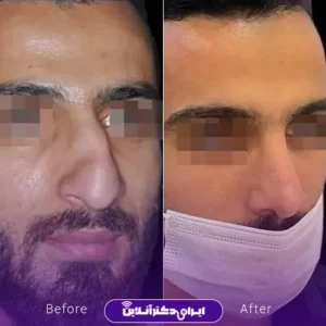 نمونه کار عمل بینی دکتر شیما کمندی 9
