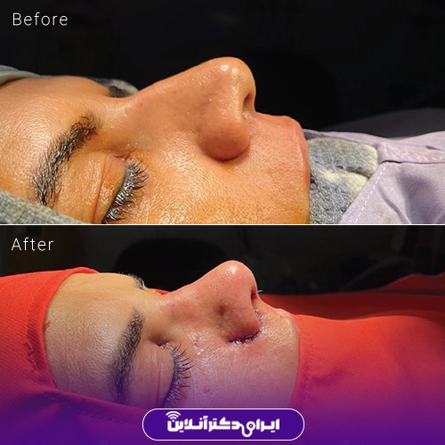 بهترین جراح بینی گوشتی در شیراز 30 نمونه کار عمل بینی دکتر سیاوش معتضدیان 3