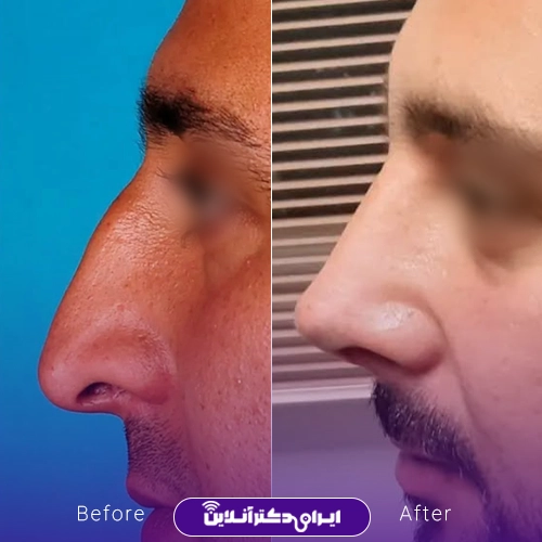 بهترین جراح انحراف بینی در اصفهان + لیست 9 مورد از بهترین جراحان 79 نمونه کار عمل بینی دکتر زهرا رستگار 7