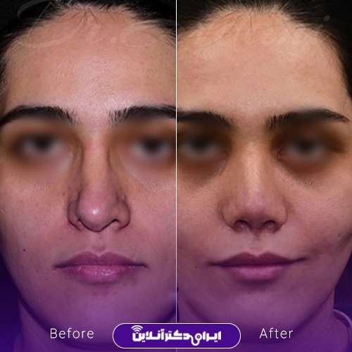 بهترین جراح بینی ترمیمی در تهران؛ معرفی 17 پزشک برتر 58 Example of nose repair surgery by Dr. Ali Javadani1