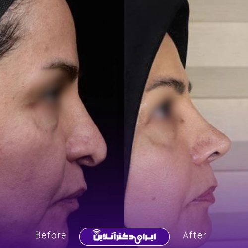 بهترین جراح بینی ترمیمی در تهران؛ معرفی 17 پزشک برتر 63 Example of nose repair surgery by Dr. Hamidreza Rasti in Tehran1