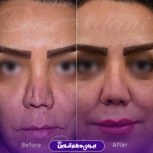 بهترین جراح بینی ترمیمی در تهران؛ معرفی 17 پزشک برتر 60 Example of nose repair surgery by Dr. Javdani Tehran3