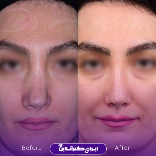 بهترین جراح بینی ترمیمی در تهران؛ معرفی 17 پزشک برتر 61 Example of nose repair surgery by Dr. Javdani in Tehran4