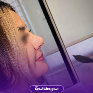 نمونه کار عمل بینی دکتر مجتبی نادیان جراح بینی 1