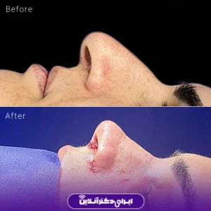 نمونه کار عمل بینی دکتر مجتبی نادیان جراح بینی 2