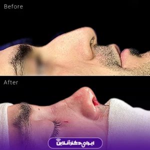 نمونه کار عمل بینی دکتر مجتبی نادیان جراح بینی 4