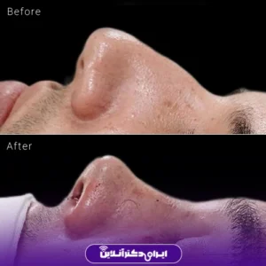 نمونه کار عمل بینی دکتر مجتبی نادیان جراح بینی 5