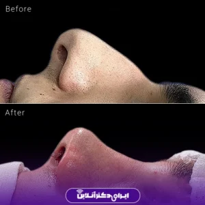 نمونه کار عمل بینی دکتر مجتبی نادیان جراح بینی 8