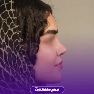 نمونه کار عمل بینی دکتر لیلا ملکی 2