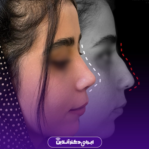 نمونه کار عمل بینی دکتر سید علی عقیلی 2