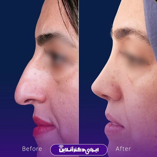 نمونه کار عمل بینی دکتر سید علی عقیلی 5