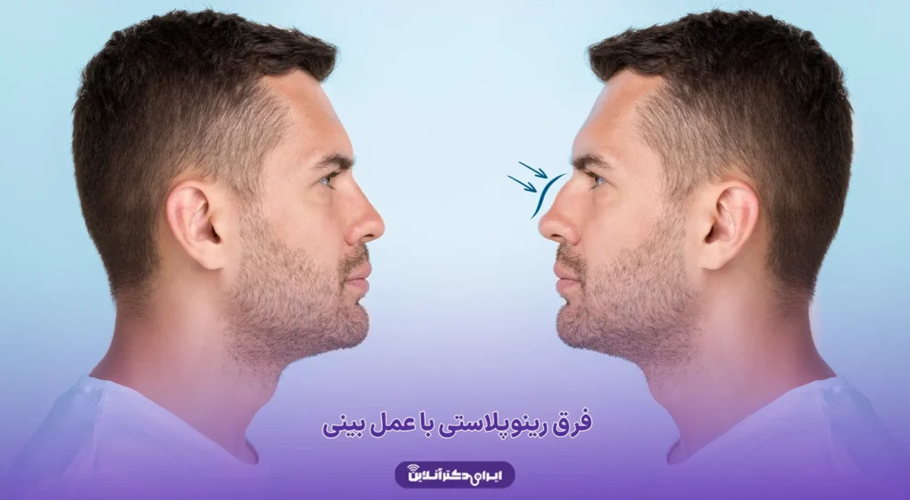 فرق رینوپلاستی با عمل بینی (مقایسه و بررسی تفاوتهای رینوپلاستی با عمل بینی) 14 فرق رینوپلاستی با عمل بینی
