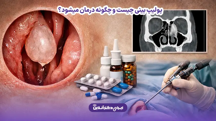 پولیپ بینی چیست؟ بررسی علائم و راههای درمان 2 پولیپ بینی چیست و چگونه درمان میشود؟