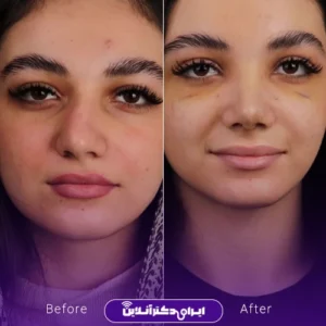 نمونه کار قبل و بعد جراحی زیبایی بینی دارای انحراف دکتر نجمه برخورداری در کرمانشاه