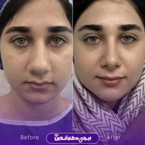 عکس قبل و بعد جراحی بینی گوشتی دکتر نجمه برخورداری در کرمانشاه