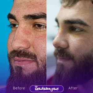 نمونه کار قبل و بعد جراحی بینی مردانه گوشتی دکتر نجمه برخورداری در کرمانشاه