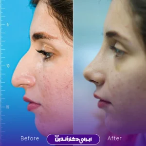 نمونه کار قبل و بعد جراحی بینی استخوانی قوز دار دکتر نجمه برخورداری در کرمانشاه