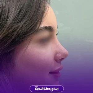 نمونه کار عمل بینی دکتر آرش طهماسبی 2
