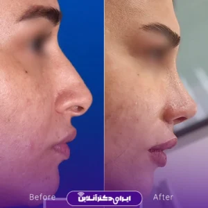 نمونه کار عمل بینی دکتر آرش طهماسبی 9