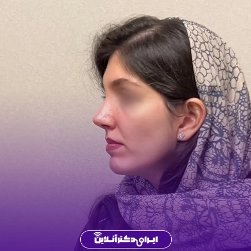 بهترین جراح بینی در تبریز + راهنمای عمل بینی سال 1405 91 نمونه کار عمل بینی دكتر داود مقبولى در تبریز 1