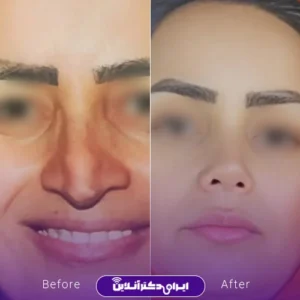 نمونه کار عمل بینی دکتر فرید عطار 3