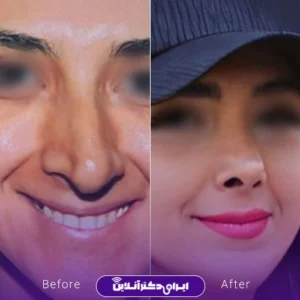 نمونه کار عمل بینی دکتر فرید عطار 1
